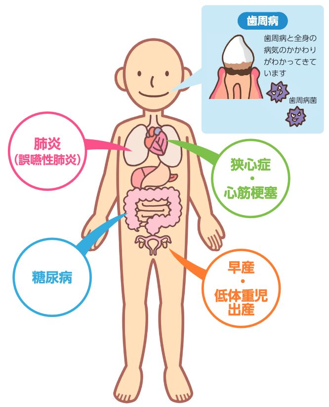 歯周病と全身疾患の関係 | 富山県歯科医師会